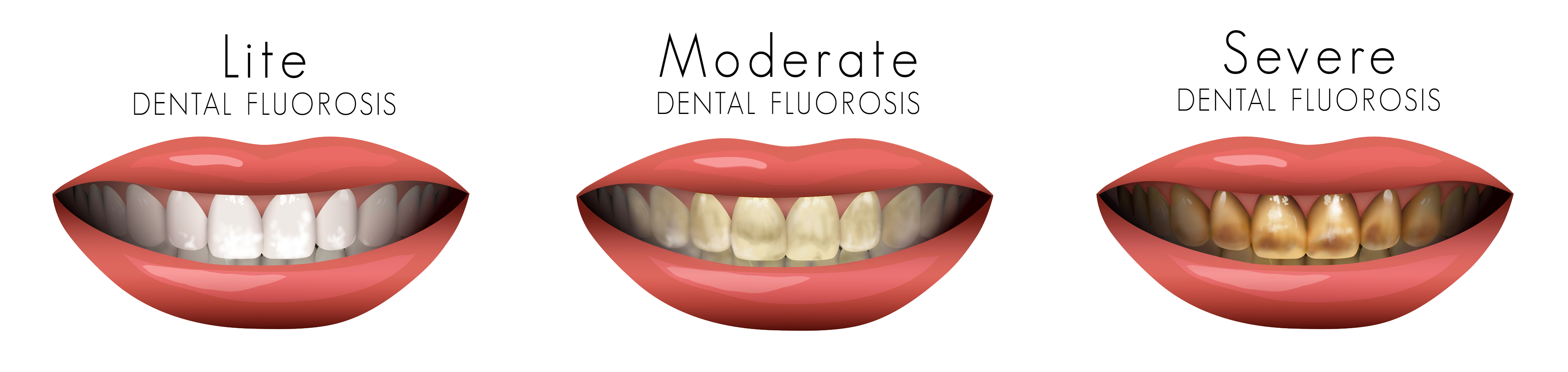 dental fluorosis chart