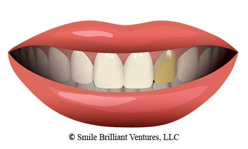 whiten single dark tooth